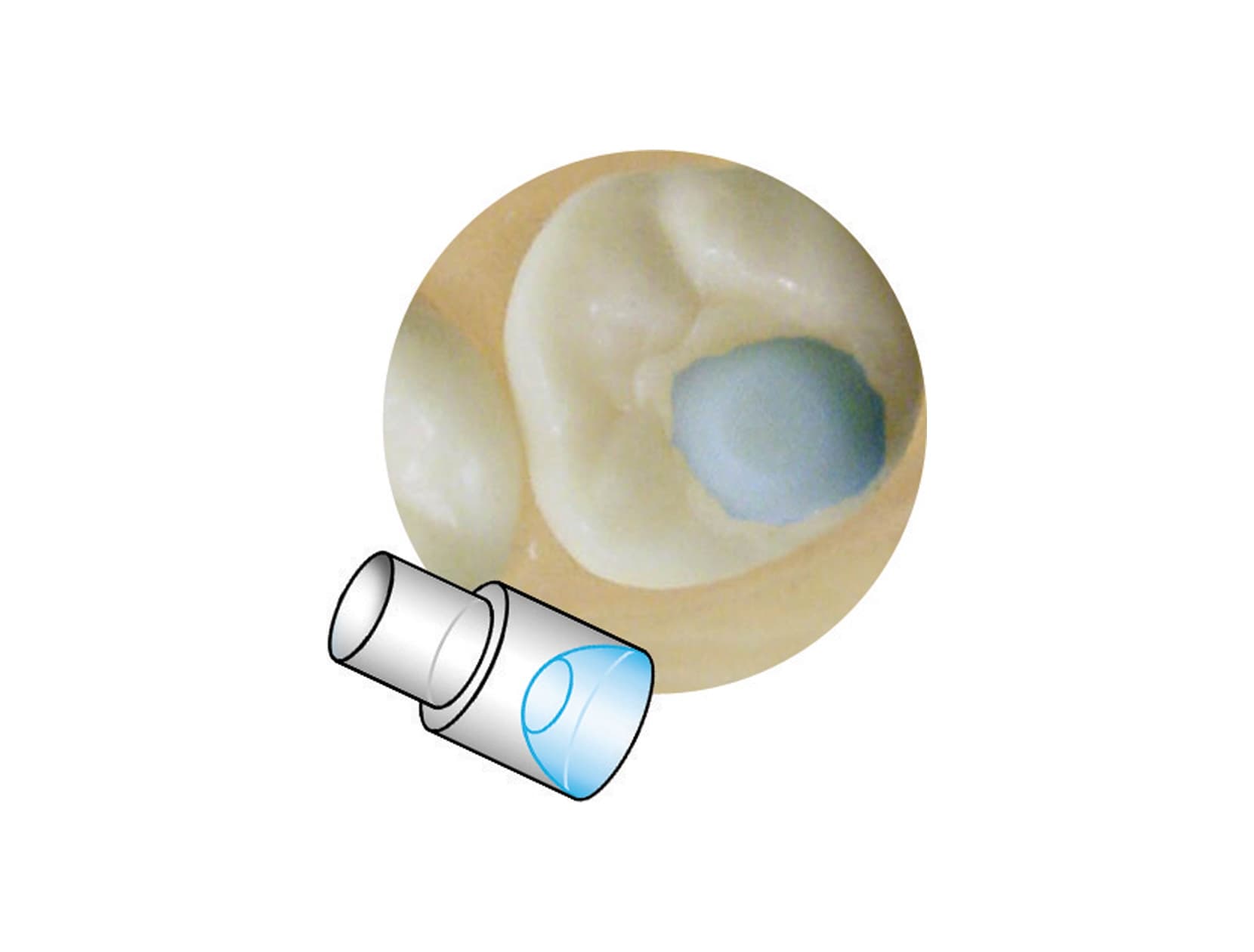 Attachements Mini Mold – Butées de surélévation Molaire